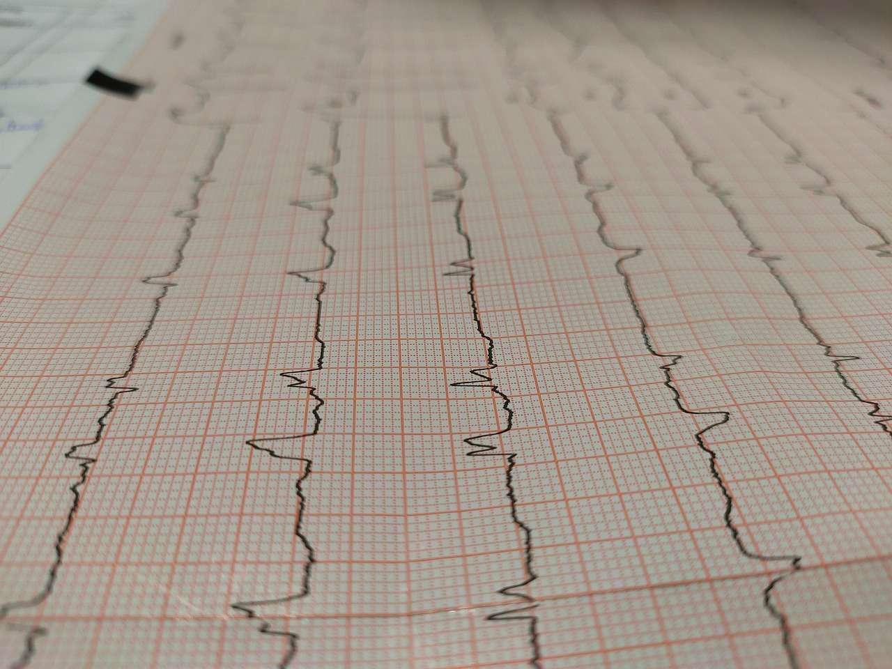 ECG myocardial infarction ECG myocardial infarction