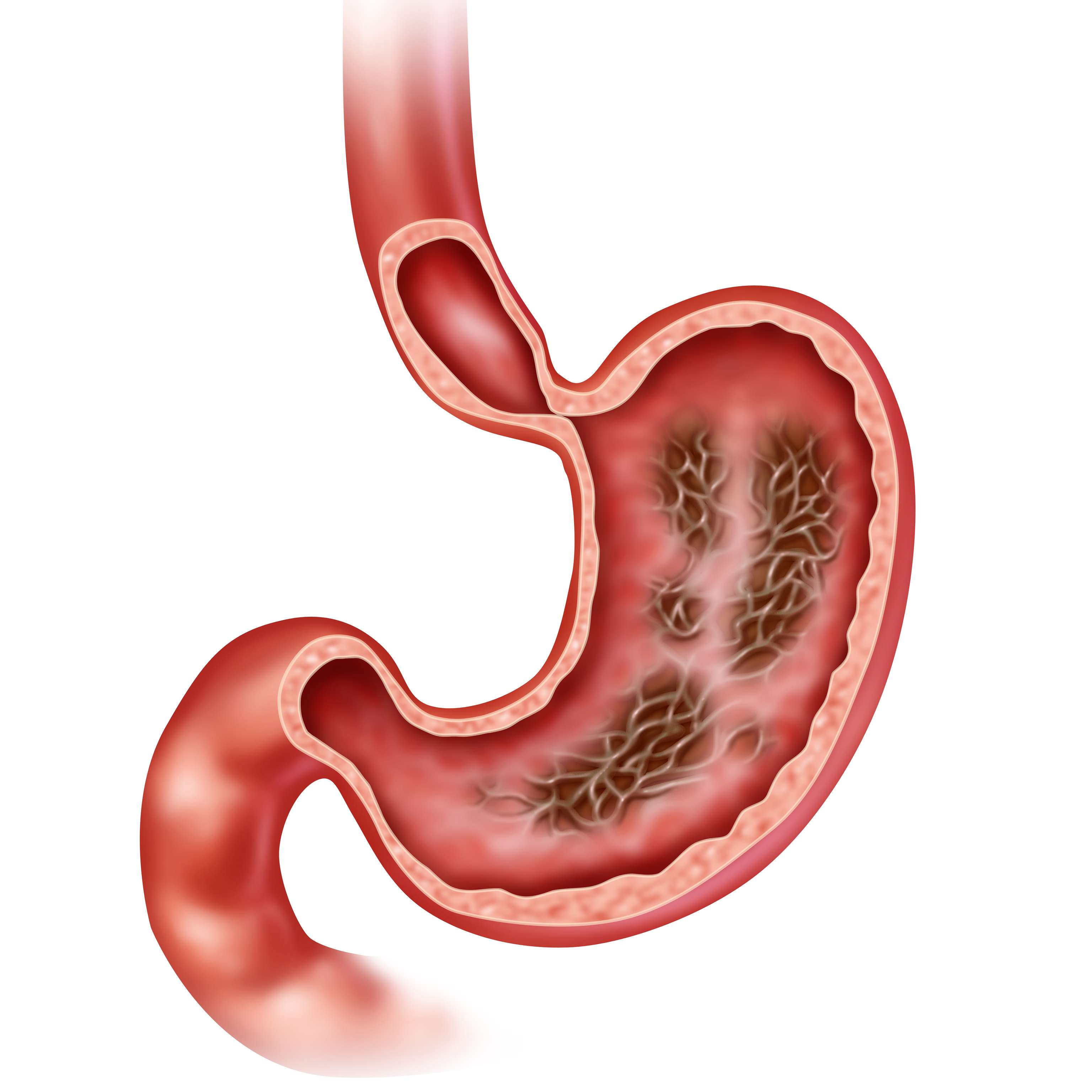 Gastritis gastrointestinal disease Illustration of the stomach with gastritis