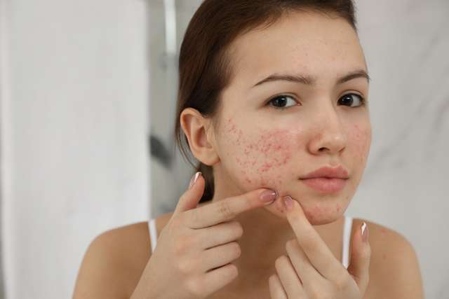 A woman squeezes a pimple Teen girl with acne problem squeezing pimple indoors