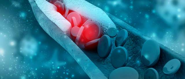 3D imaging of blood cells with plaque build-up of cholesterol 3D imaging of blood cells with plaque build-up of cholesterol Symbol for vascular disease