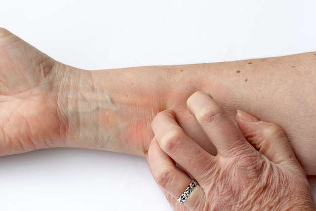 A woman scratches her arm Itching reddened skin - A woman scratches her arm