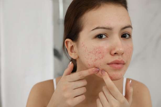 Een vrouw knijpt een puistje uit Tienermeisje met acne probleem knijpt puistje naar binnen
