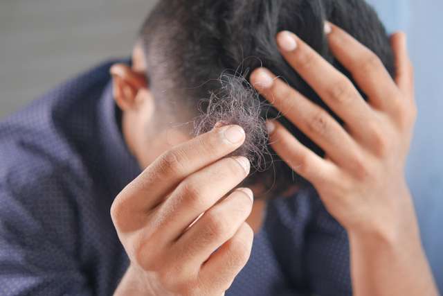 Hair Hand Issue Mann hält ausgefallene Haare in der Hand