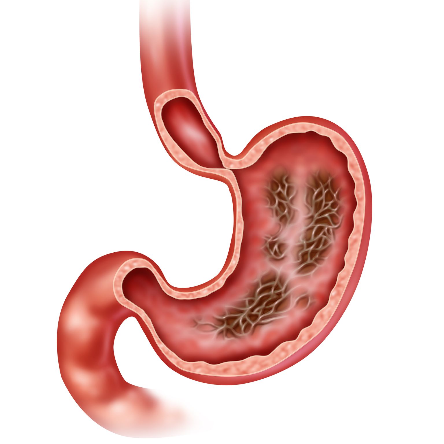 Illustrazione dello stomaco con gastrite