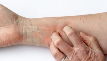 Prurito alla pelle arrossata - Una donna si gratta il braccio